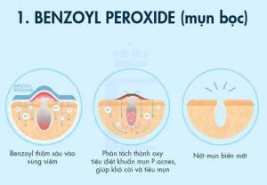 Benzoyl-Peroxide - thành phần trị mụn viêm hiệu quả