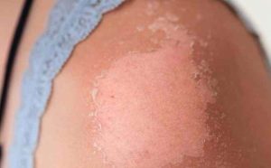 Cách chăm sóc và phục hồi da bị cháy nắng